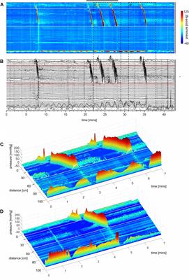 Characterization of Simultaneous Pressure Waves as Biomarkers for Colonic Motility Assessed by High-Resolution Colonic Manometry